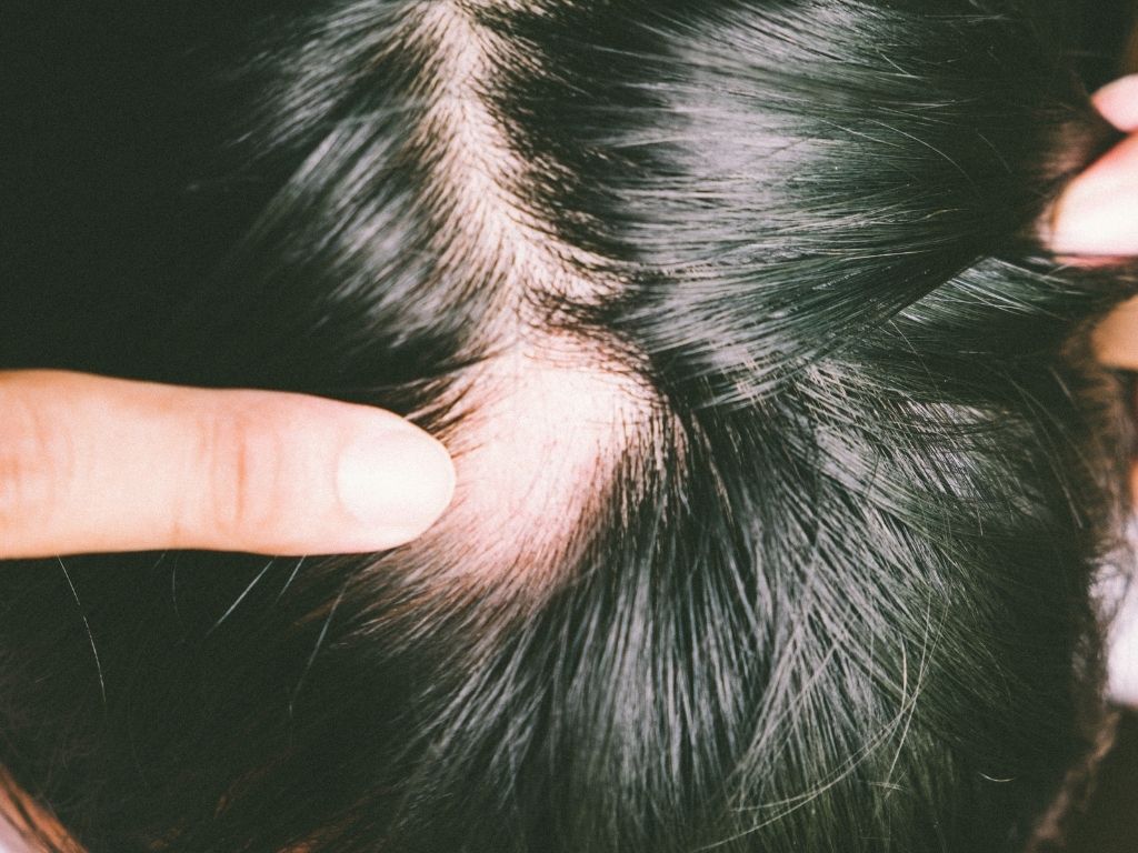 Dealing With A Bald Spot On Crown Of Head Tips For Men And Women